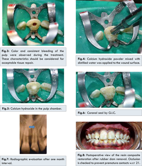 Partial Pulpotomy for Complicated Crown Fractures in Immature Permanent